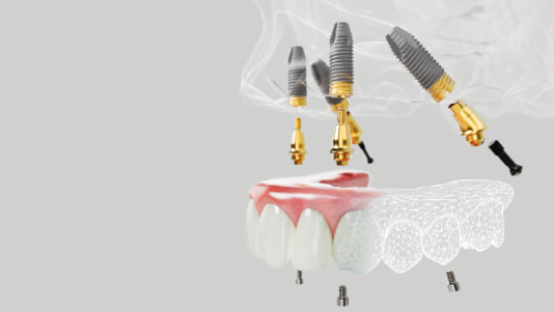 Implant dentaire