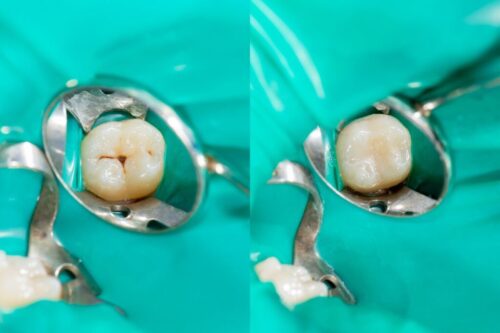 dental sealent